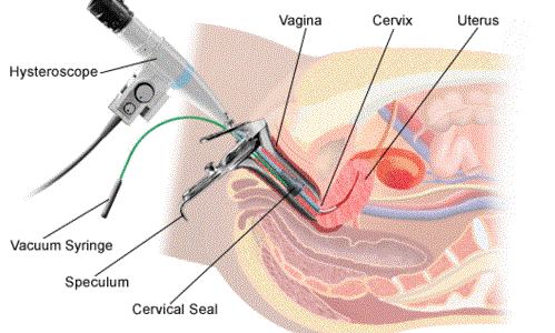 Hysteroscopic Surgeries in Rahata Shirdi Ahmednagar